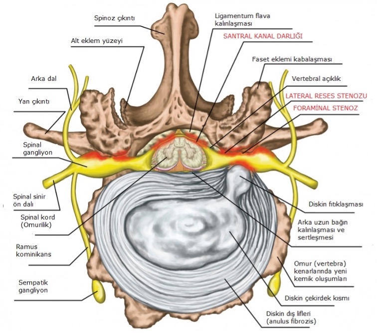 Spinal stenoz omurilik darlığı