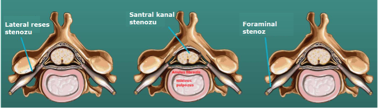 spinal stenoz